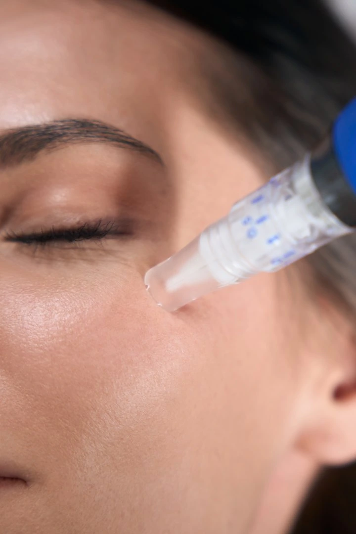 Close-up of woman receiving SkinPen Microneedling treatment on cheek
