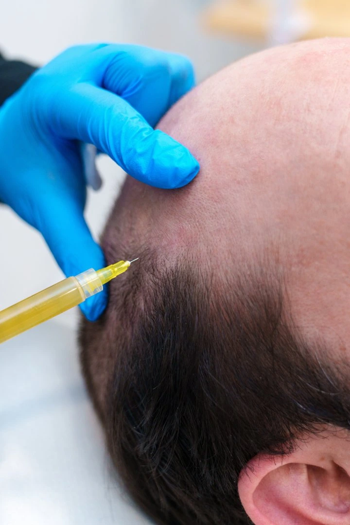 A man receiving a PRF Hair restoration injection for hair growth