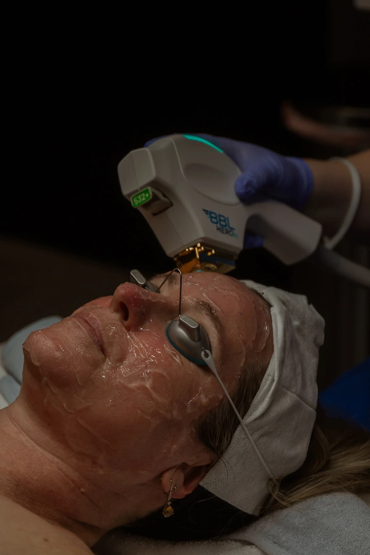 BBL Heroic Moxi facial treatment performed on woman with eye protection