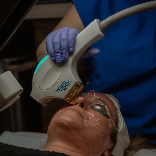 Woman undergoing BBL Heroic Moxi skin treatment with protective eye gear